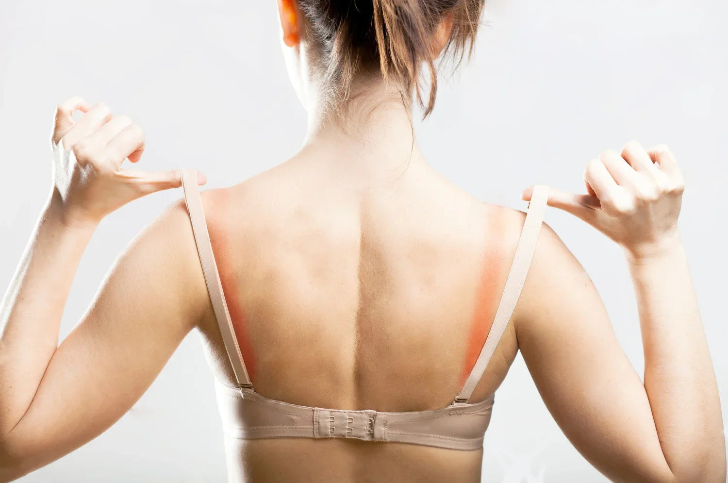 Woman with bra strap irritation and red marks on sensitive skin, back view