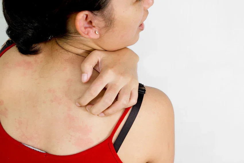 Woman scratching red itchy rash on back, signs of skin irritation or allergy
