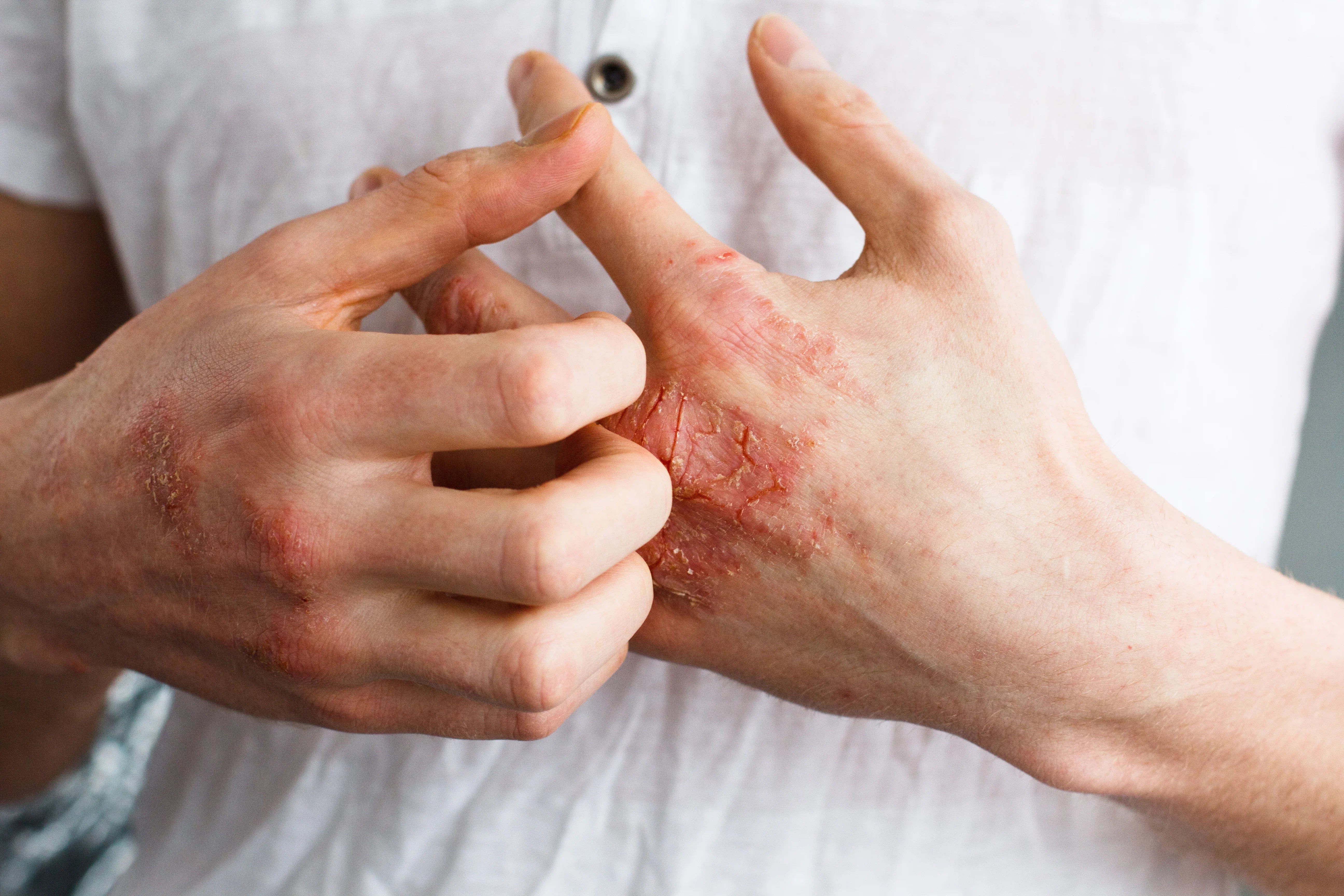 Close-up of hands with irritated, red eczema flare-up on skin, person wearing white shirt