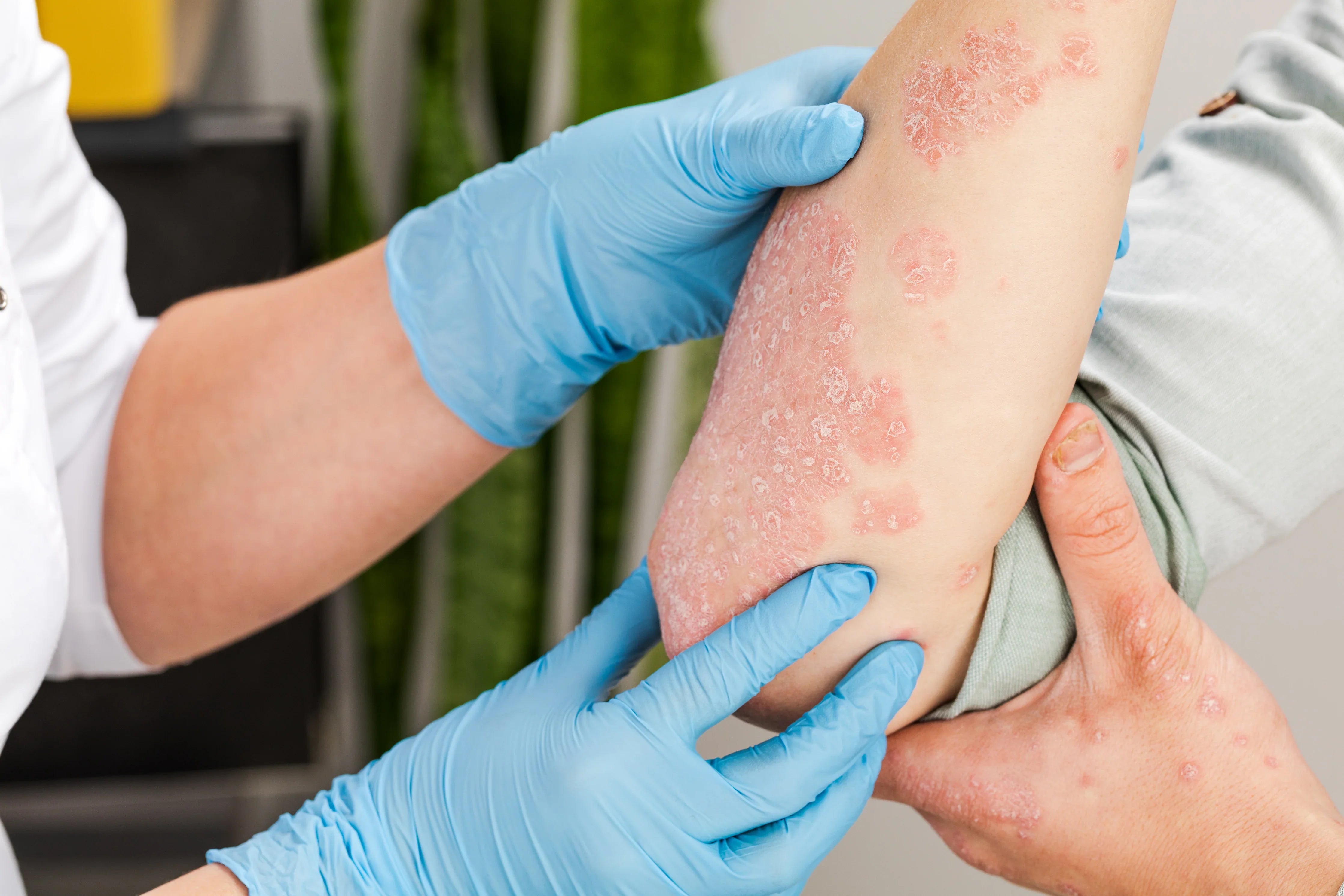 7 Types of Psoriasis