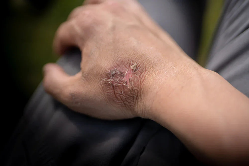 Relieving That Post-Burn Itch