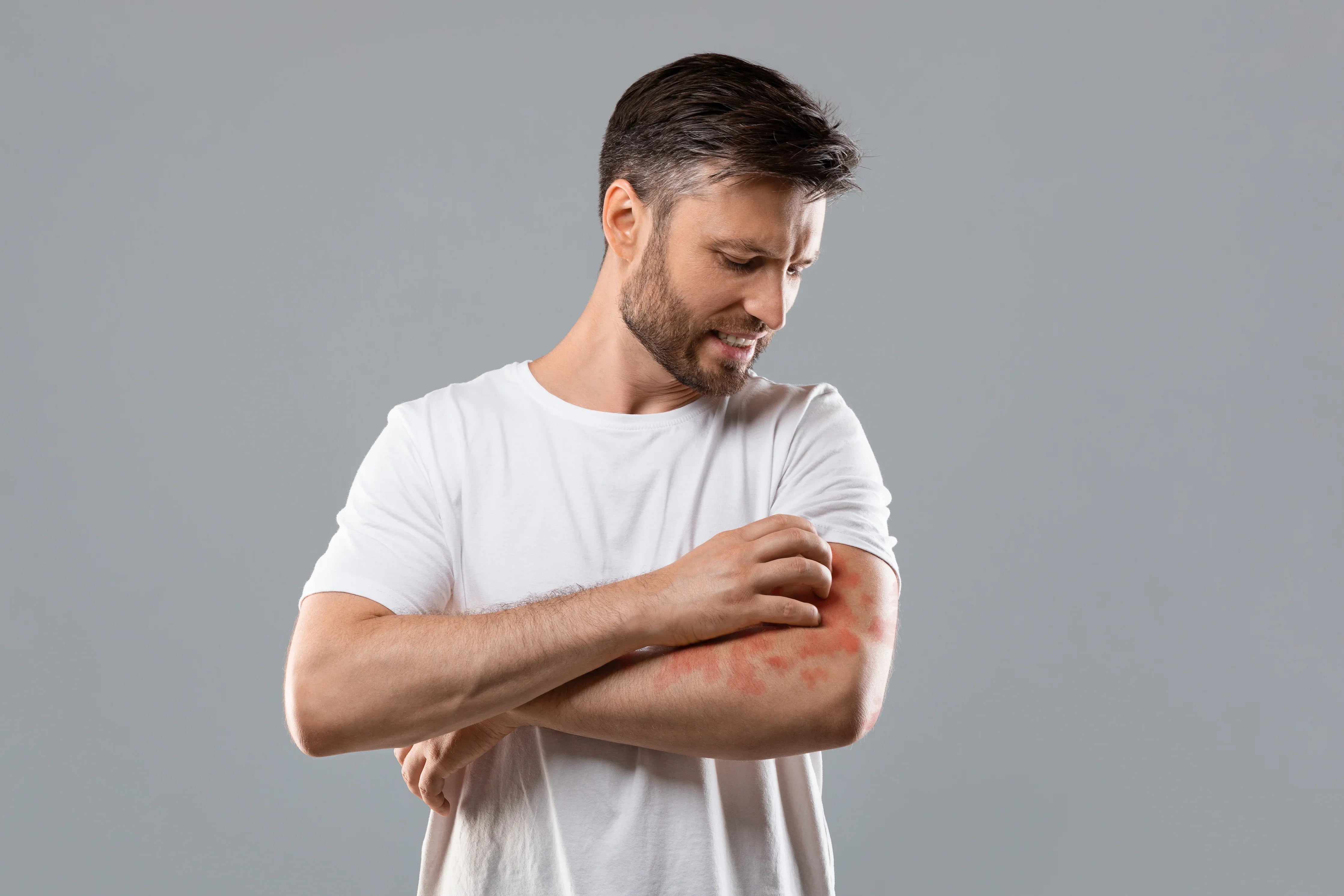 Man in white cotton shirt scratching red irritated skin on arm, eczema and sensitive skin
