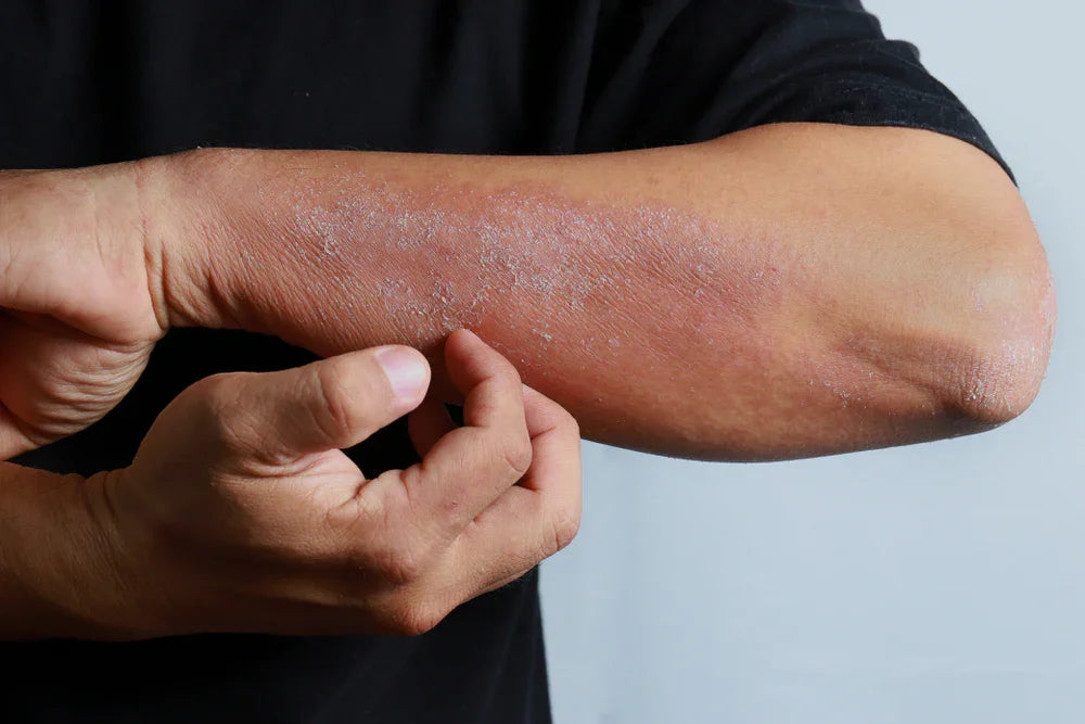 Person with eczema on forearm scratching dry, irritated skin