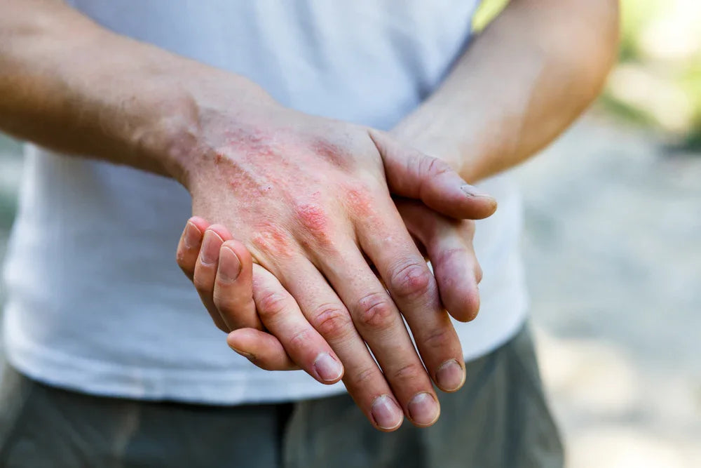 Person with irritated skin or eczema on hands, wearing a white shirt outdoors
