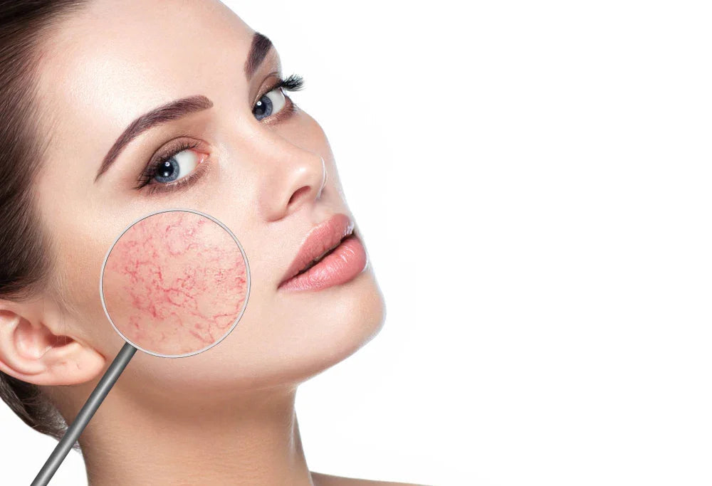 Woman with sensitive skin, showing facial redness and irritation under magnifying glass