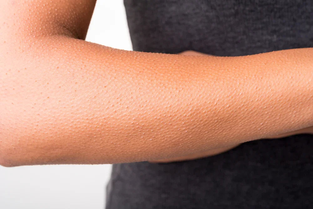 Close-up of an arm with goosebumps, highlighting sensitive skin and hypoallergenic needs.