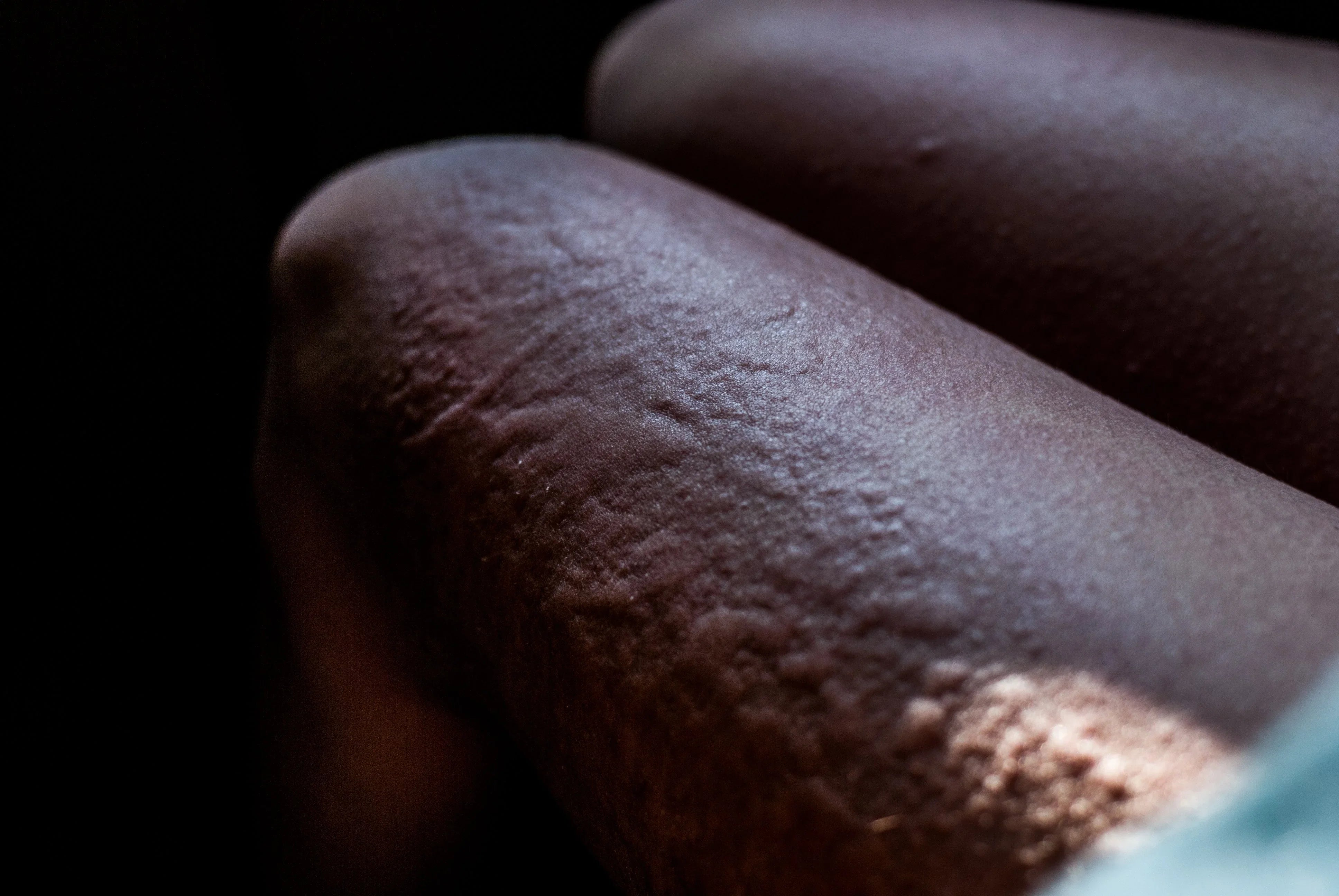 Close-up of eczema or dry, irritated skin on a person's legs, highlighting sensitive skin