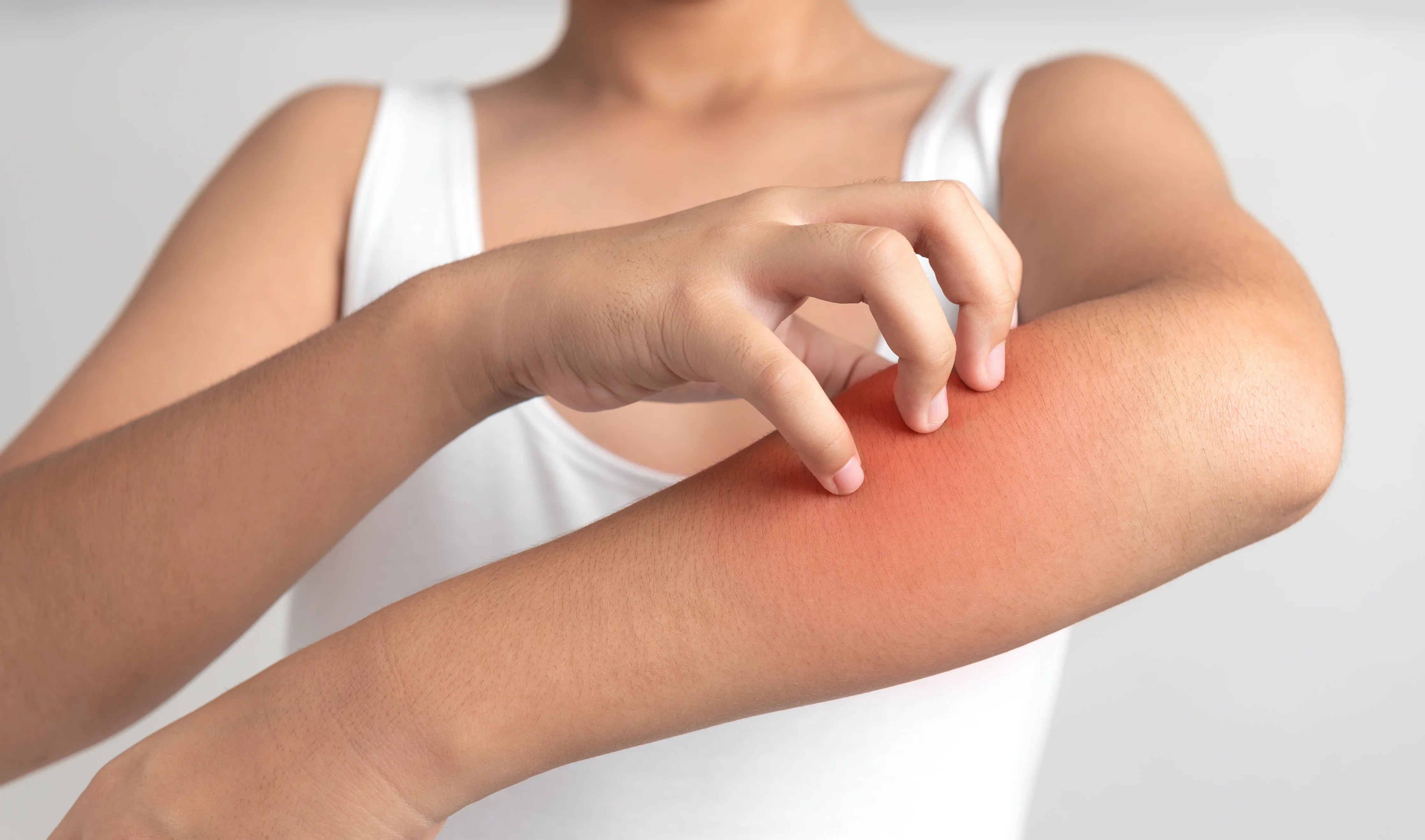 Person scratching irritated red skin on arm, eczema and sensitive skin concept