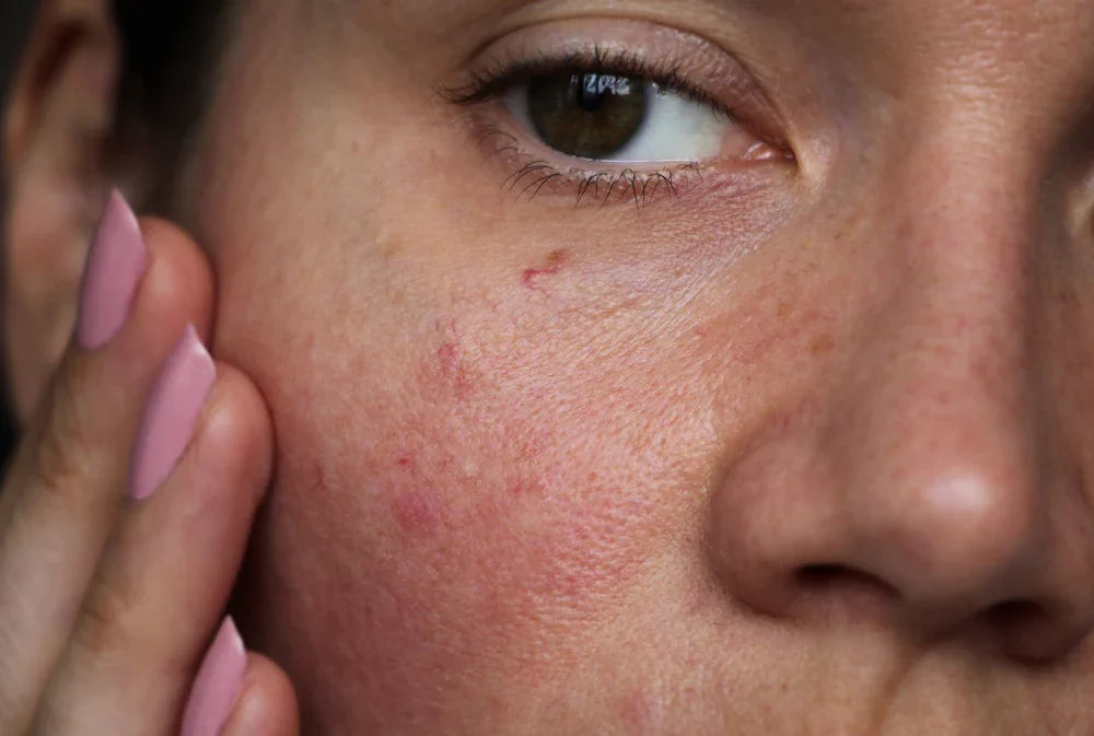 Close-up of a woman with irritated, red sensitive skin on her cheek