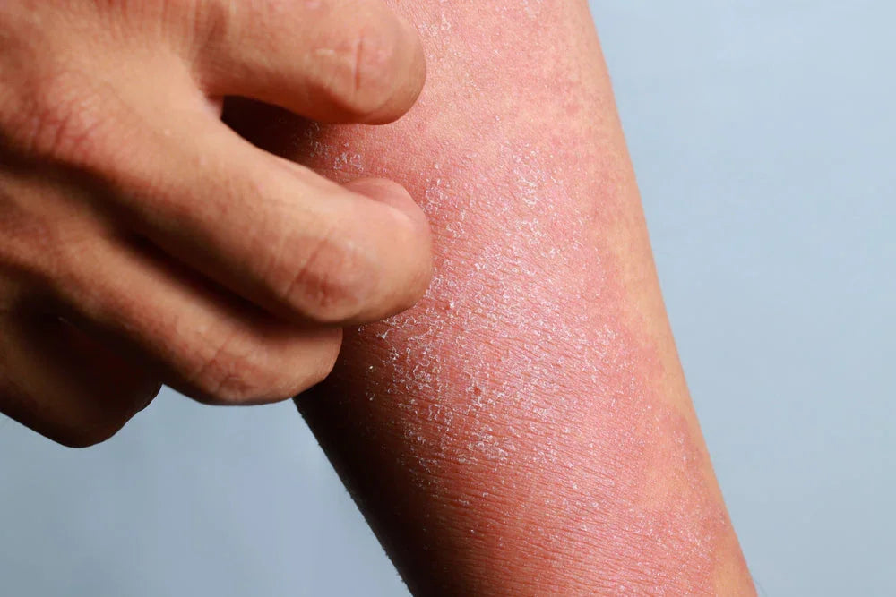 Close-up of a person scratching dry, irritated skin, showing eczema and sensitive skin symptoms.