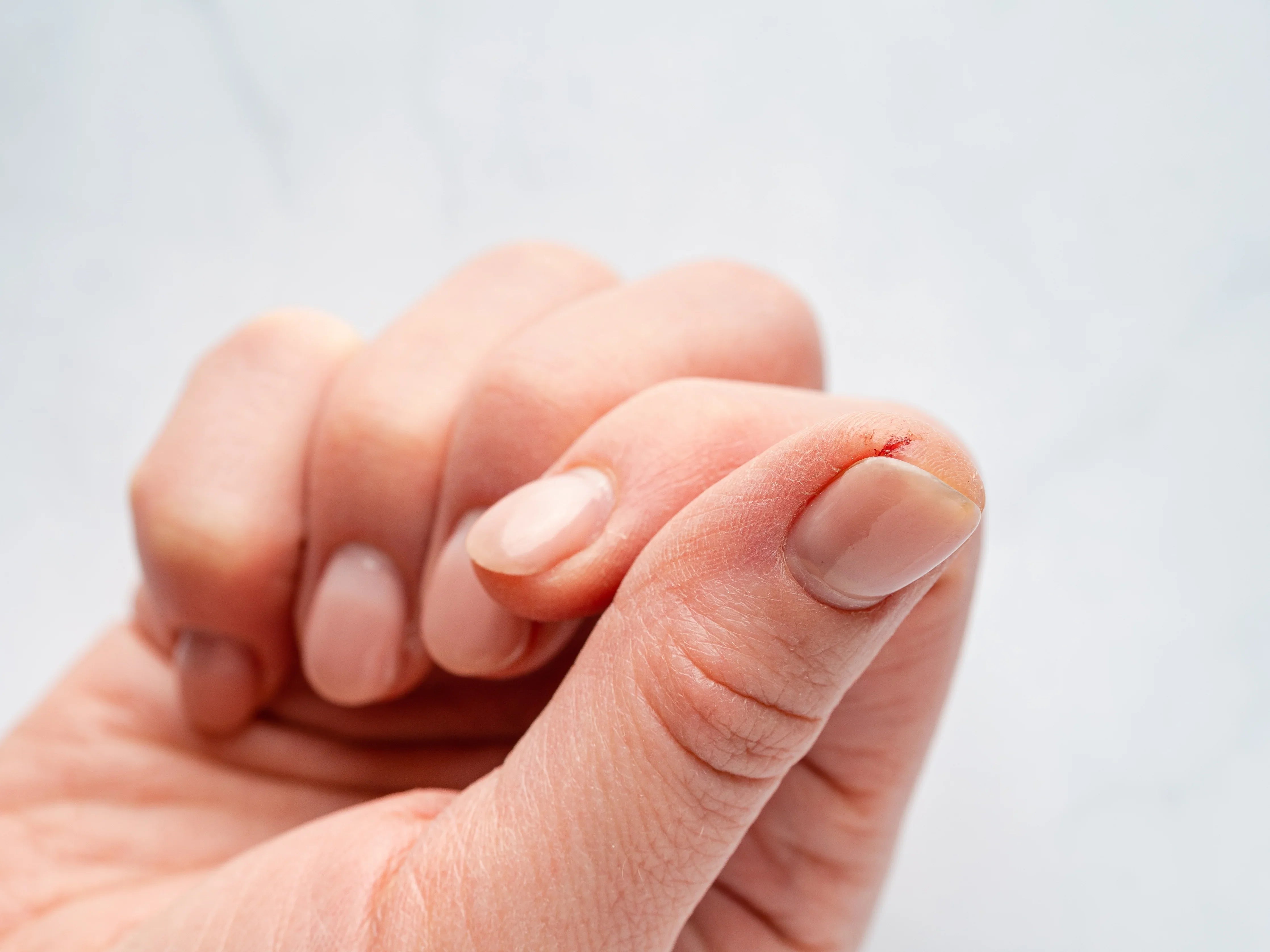 Close-up of a hand with dry, cracked skin and a small cut near the fingernail