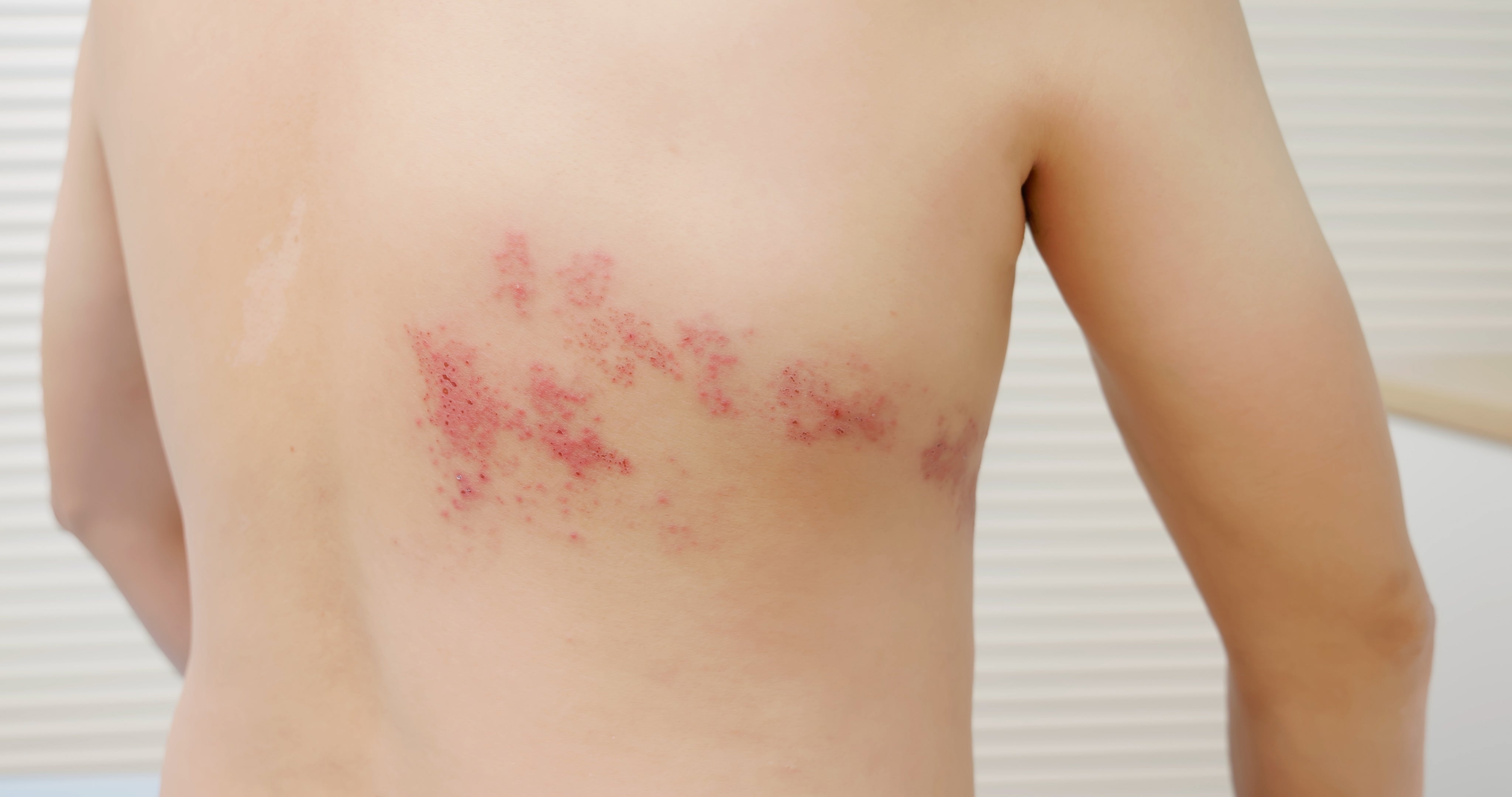 Ater Pressure Rash Pressure Urticaria: Symptoms and Clothing Tips | Cottonique ...