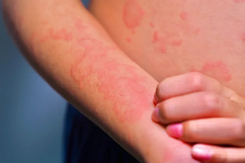 Close-up of an arm with red skin irritation, allergy rash, related to hypoallergenic apparel needs.