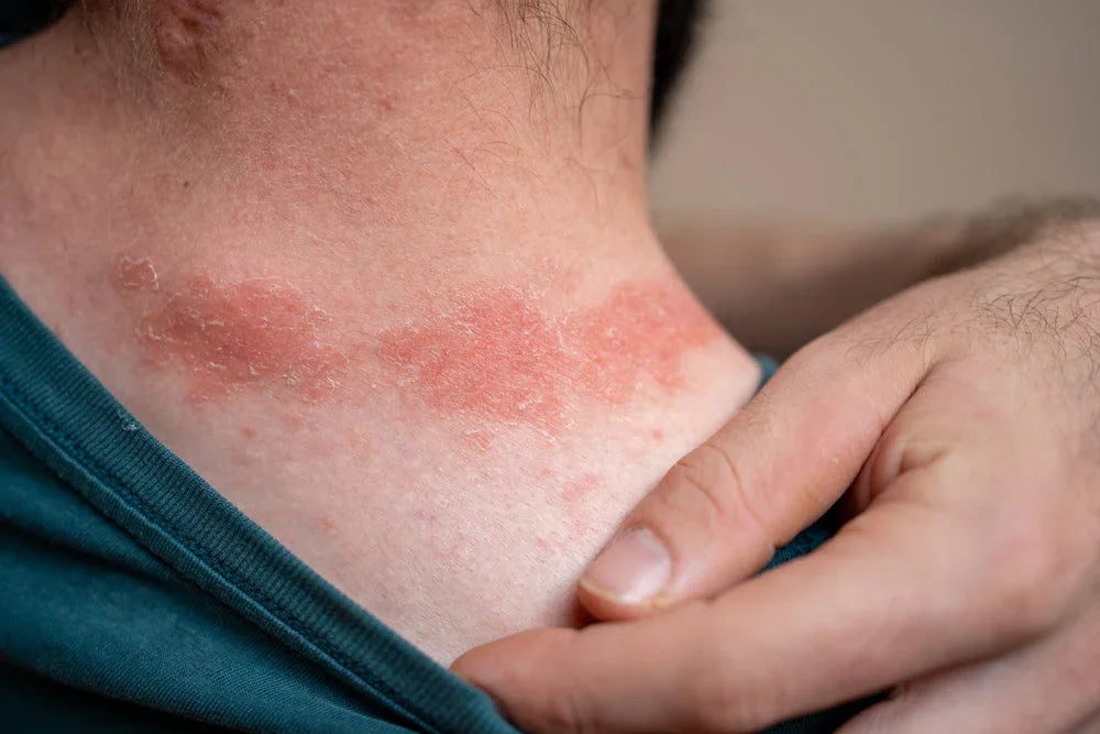Person with red, irritated eczema rash on neck wearing cotton shirt