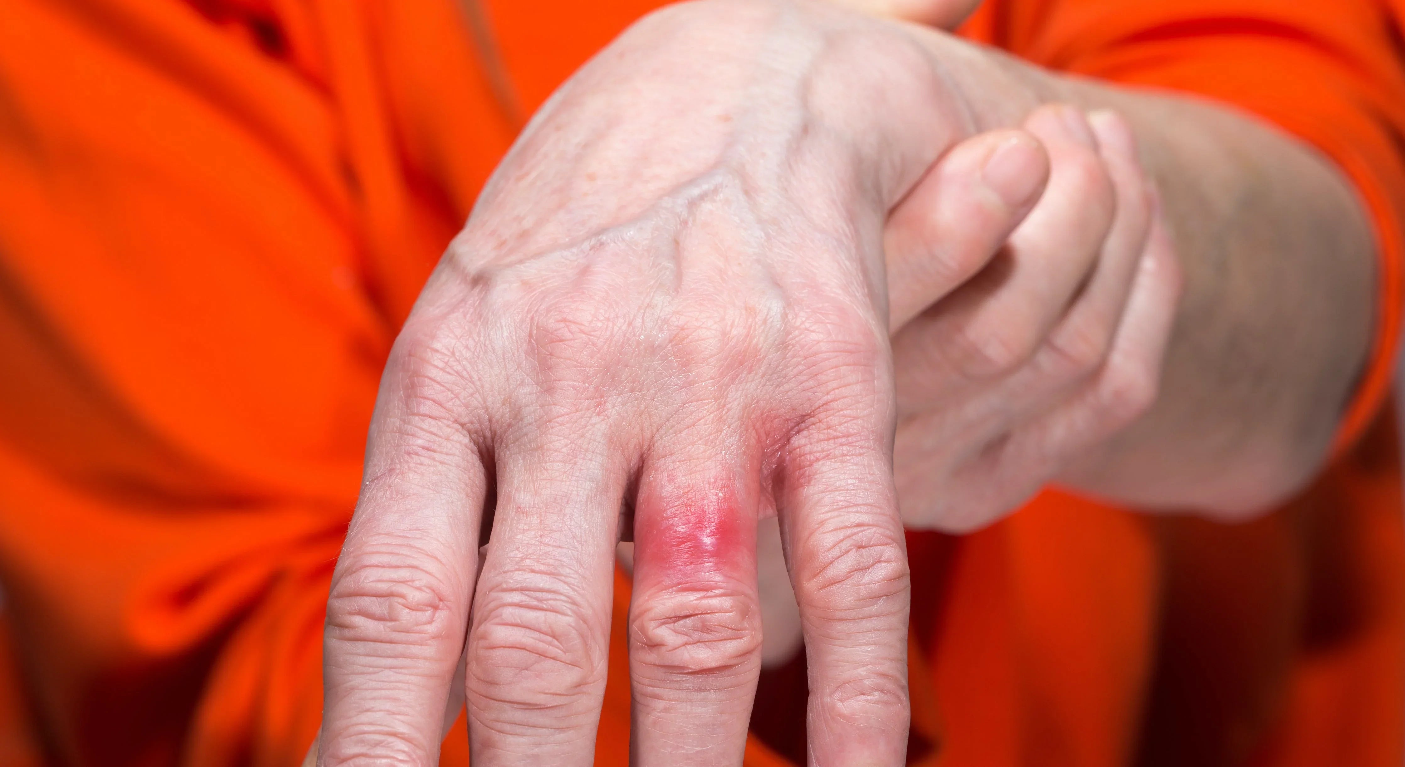 Hand with red irritated skin on finger, possible eczema or dermatitis flare-up