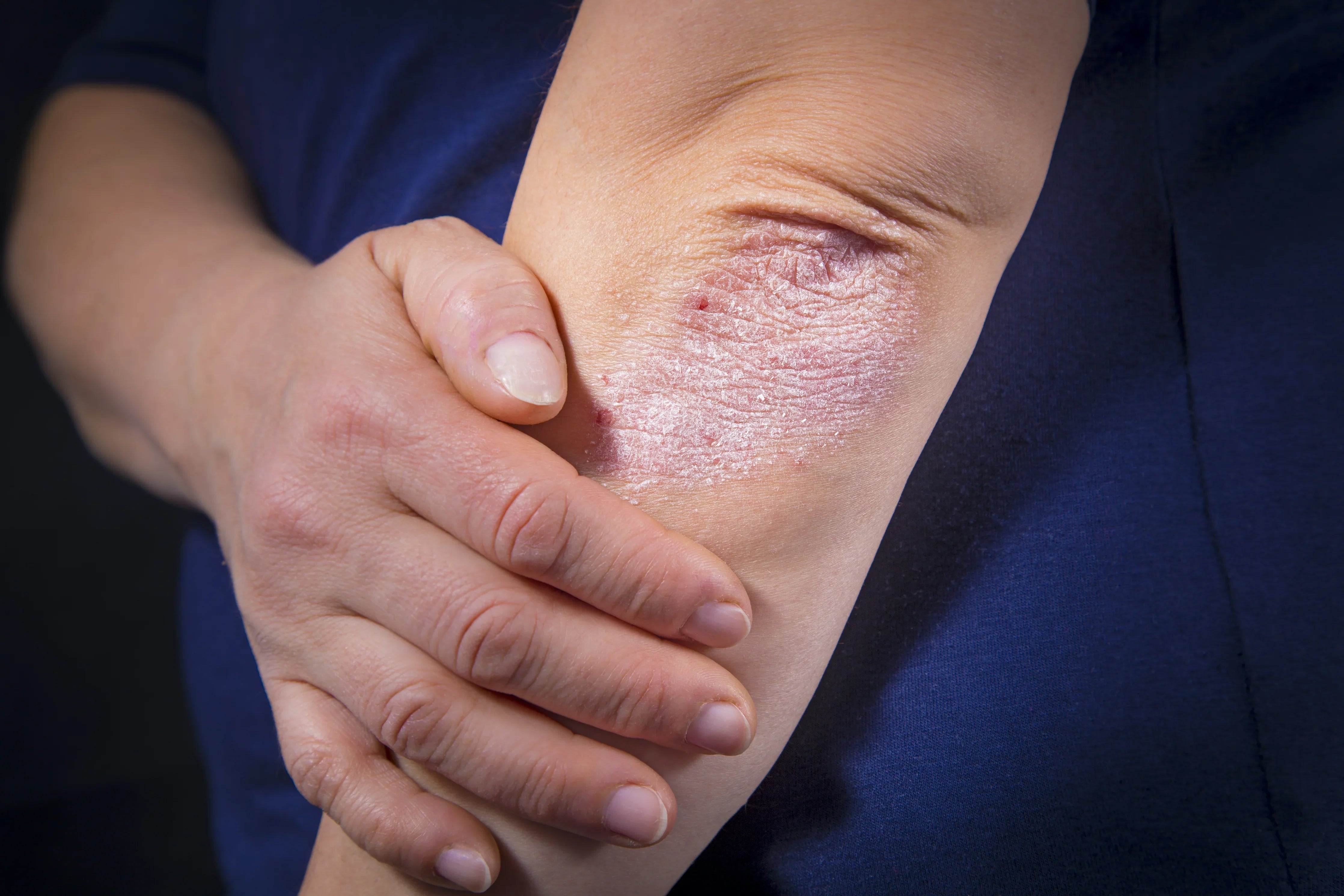 Close-up of a person with eczema or irritated skin on their elbow, wearing a blue shirt